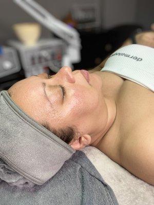 Dermaplaning with peel