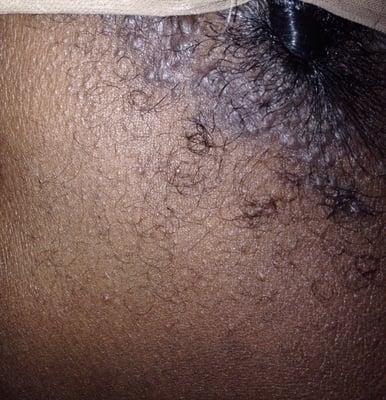 Rash from having my hair twisted here.