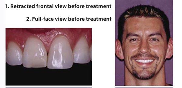 Full mouth restorations by Montgomery Dental Care in Woodbury, MN