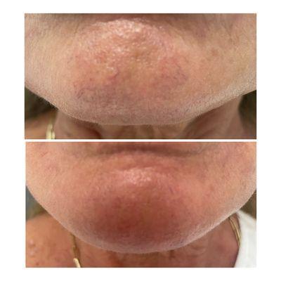 Getting rid of unwanted facial veins with just 1 IPL treatment! Face, leg treatments available