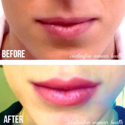 Our patient after receiving 1 syringe of Restylane-L to enhance her lips!