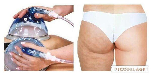 Cellulite  treatment