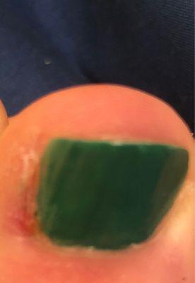 Sliced nailed bed/ flesh wide open with cuticle tool