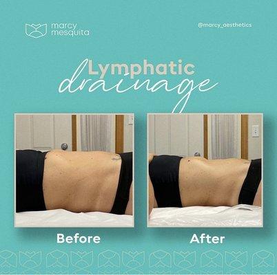 Manual Lymphatic Drainage