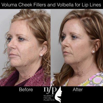 This patient had great results with Volbella to treat the stubborn lines around the mouth, called the "straw lines" or "smoker's lines".