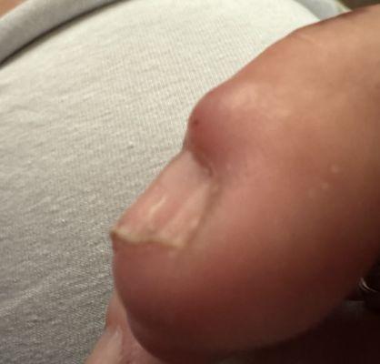 Really bad infection from the acrylic nails