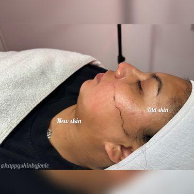 Dermaplaning treatment