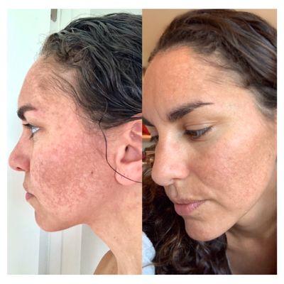 Results of 2 Nano Skin Refining Facials along with daily use of proper at home regimen