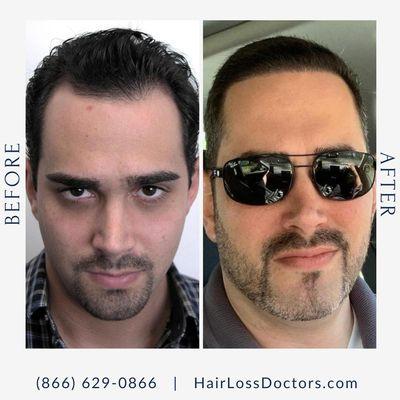 Male Before / After Sample from The Hair Loss Doctors By Robert J. Dorin with Surgical Headquarters in Garden City, NY.