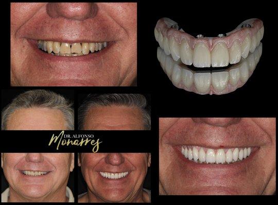 Full mouth reconstruction with dental implants by Dr. Alfonso Monarres. All on 4 zirconia prosthesis by Yesenia Monarres.