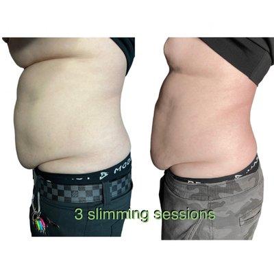 Before and after 3 slimming sessions