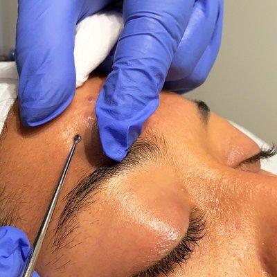 Acne Facial - Extractions