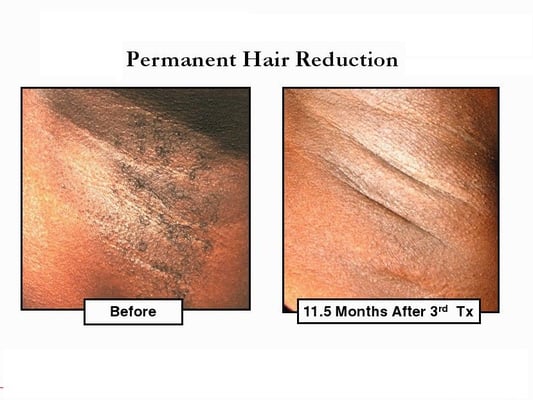 Hair Removal