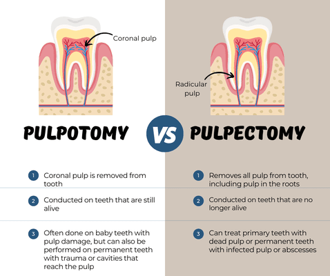 Do you know the differences between a pulpotomy and a pulpectomy?