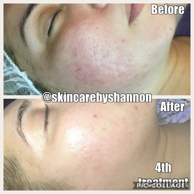 Results after 4 sessions of microneedling for acne scars