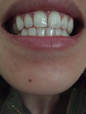 After cleaning all the plaque and coffee stains, my teeth are as sparkly as ever! Thanks Dr. Lee!