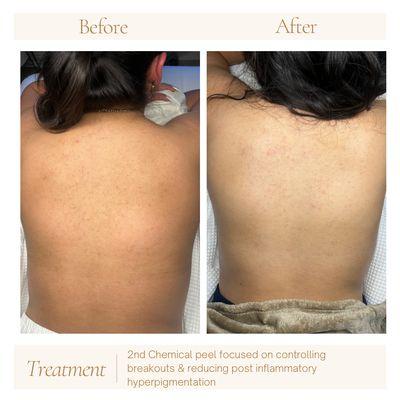 Chemical Peel Body Treatment to treat discoloration from previous breakouts.