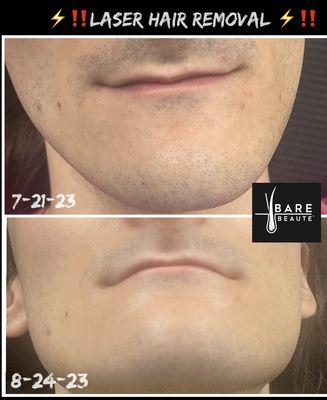 Laser hair removal treatment.