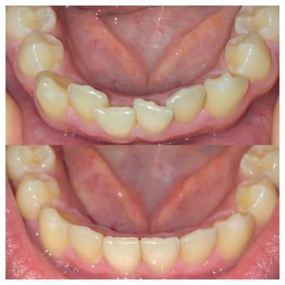 Before Invisalign (Sept. 2015) .... After Invisalign (April 2016)