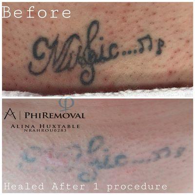 Tatoo removal! Results after one session