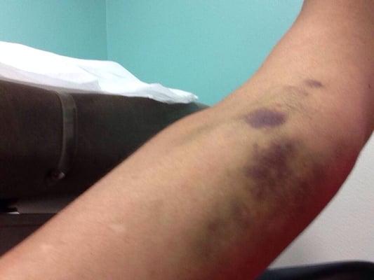 Mom's arm after phlebotomist royally screwed up