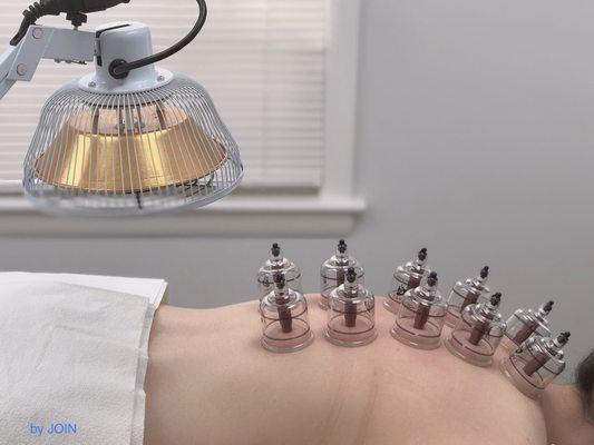 acupressure cupping