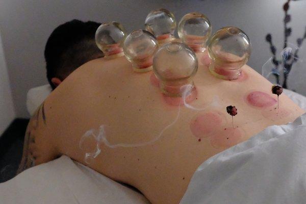 Cupping and Moxibustion, treatment for lowback pain