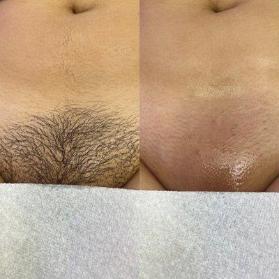 Brazilian wax