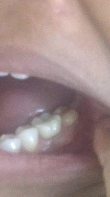 Exposed tooth after crown fell off a few weeks after procedure done.