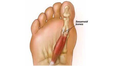 Sesamoiditis: El dedo gordo y sus dolores 4/5

NYCPodiatra.com