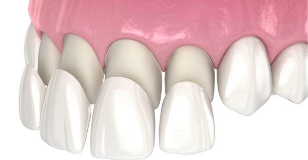 Dental veneers.