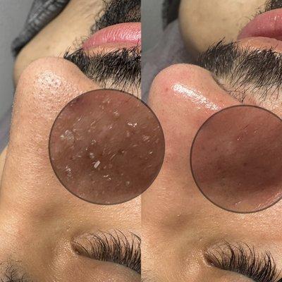 Microdermabrasion facial