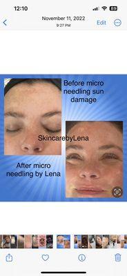 Micro-needling treatments