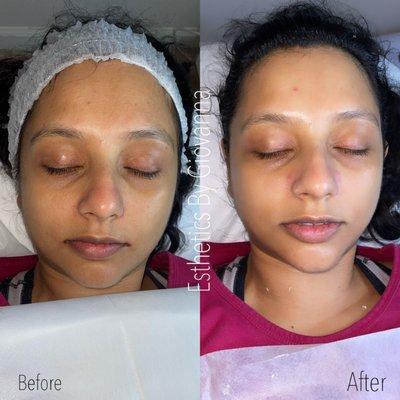 Dermaplaning & Basic Facial