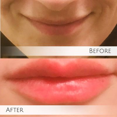 Lip Filler Special Every Month.