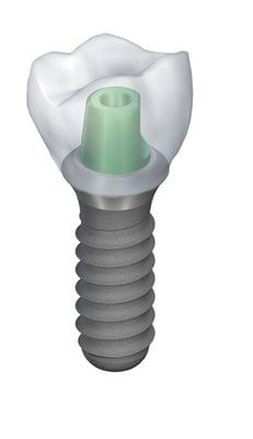 Dental Implant