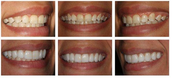 No prep veneers