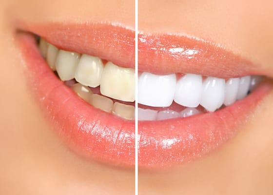 Want whiter brighter teeth?  Call our office to learn more about the best whitening systems for you!