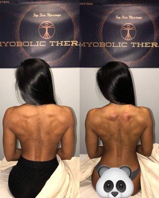 Before & After Josh's Work of Deep Tissue & Cupping