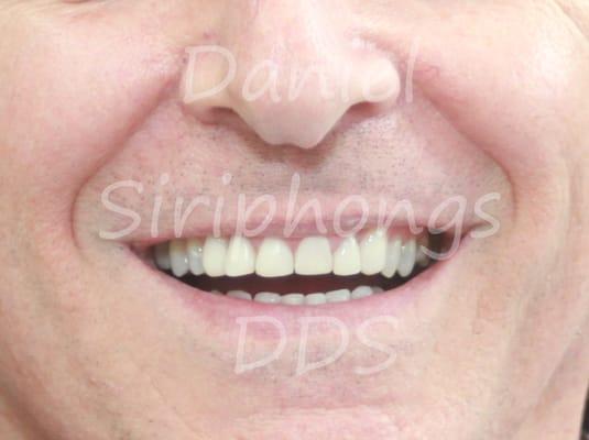 Composite veneers - done in one appointment.  Take home bleaching as well.