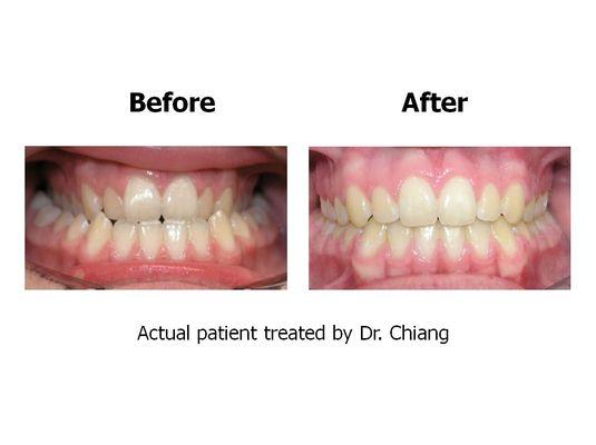 Actual patient treated by Dr. Chiang