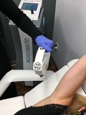 IPL Laser Hair Removal