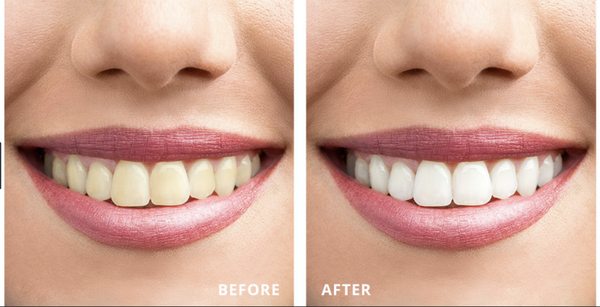 Teeth Whitening, at Zen Retreat Franklin Square NY.