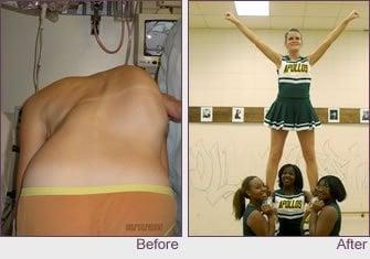 Adolescent Idiopathic Scoliosis Correction Before & After