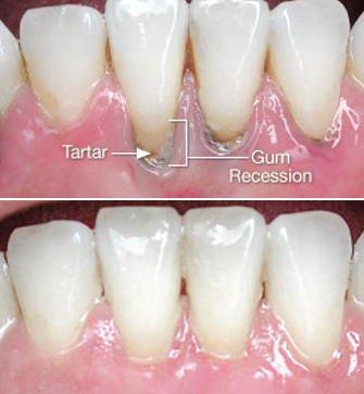 Before and After at NÜVA Smile | Bergenfield, NJ