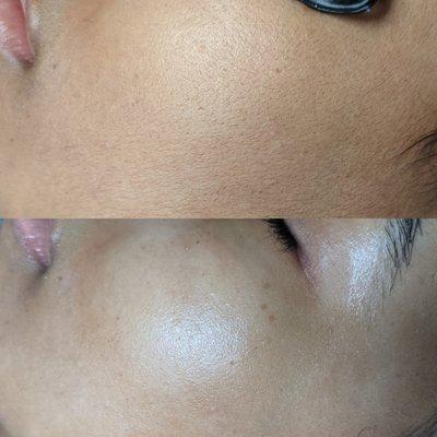 dermaplane before (top) and after