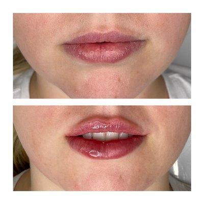 LIP FILLER