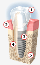 Parts of an Implant similar to natural tooth