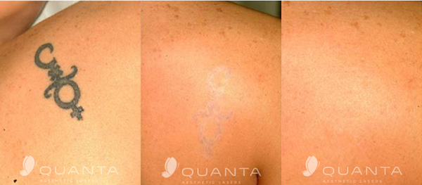 We are now doing laser tattoo removal!