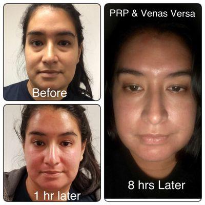 Eye treatment with PRP & Venus Versa.